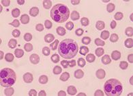 һ�����ؿ����������ˣ����ܷ��Ϊ��Ѫ֢��ɸ�������